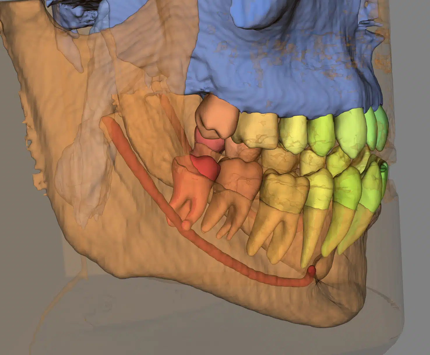 Rimuovere i denti del giudizio / terzi molari in un solo giorno? È possibile!